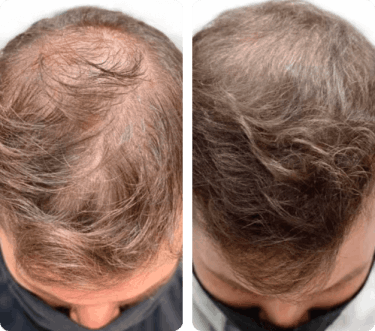 ReGenixal Hair Recover 19