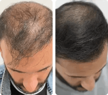 ReGenixal Hair Recover 17